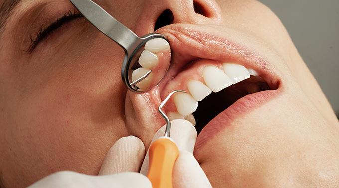 Regelmässige Kontrollbesuche beim Zahnarzt sind obligatorisch.
